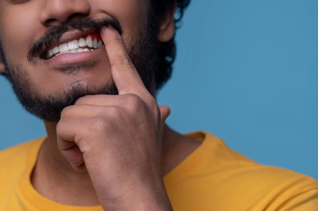 Gengivite Pode Causar a Perda do Dente? Descubra a Verdade e Proteja Seu Sorriso