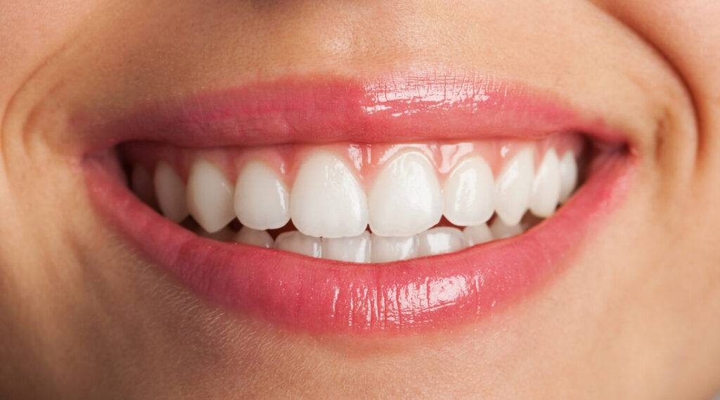 Close de sorriso feminino com dentes brancos e alinhados após clareamento dental em Brasília na Clínica Dra Viviane Amaral.